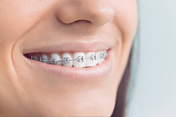 Dental Bonding in Leawood, KS